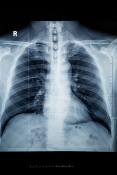A CT scan of a normal lung