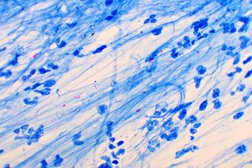 Mycobacterium tuberculosis positive (small red rod) in sputum smear, acid-fast stain, analyze by microscope