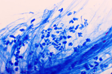 Fototapeta na wymiar Mycobacterium tuberculosis positive (small red rod) in sputum smear, acid-fast stain, analyze by microscope