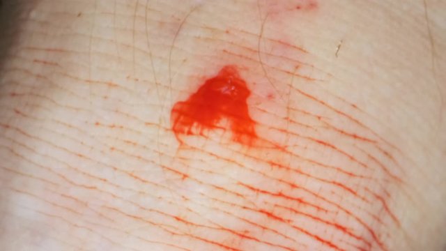 Wound and bleeding at leech bite. Close-up 