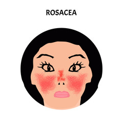 Rosacea. Rosacea Awareness Month. Infographics. Vector illustration on isolated background.