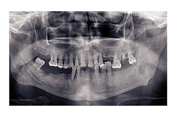 Panoramic dental x-ray of an elderly person. Bad teeth fell out. Snapshot of the pensioner's jaw. Orthopantomogram.