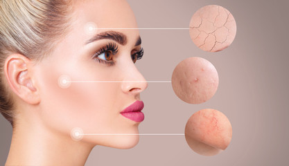 Magnifying circles demonstrate couperose and acne on face skin of young woman.