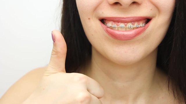 Dental braces in happy womans mouths who shows like. Brackets on the teeth after whitening. Self-ligating brackets with metal ties and gray elastics or rubber bands for perfect smile. Orthodontic teet