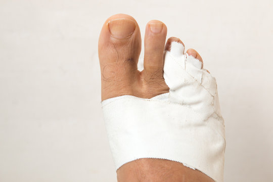 Close up of a Man&rsquo;s bandaged up broken toe 