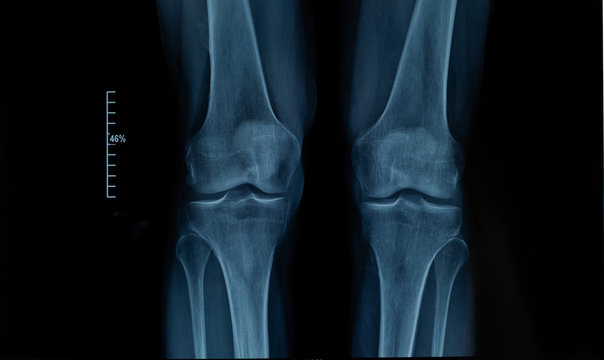 X-ray edk in the knee joint