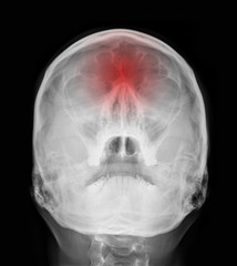 X-ray pictures - Sinus