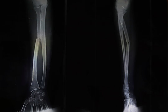 Single bone broken on x ray film.X-ray shows broken hand