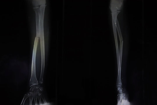 Broken radius arm bone x-ray film.X ray film shows a position changed broken hand
