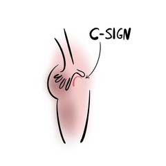 Hip pain and the C-sign