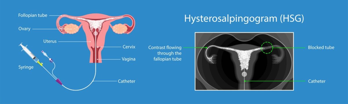 Hysterosalpingogram (HSG) Test Blocked Fallopian Tubes diagnose tubal factor infertility pregnant trouble certain sexually transmitted structural abnormalities uterine exam liquid fluoroscope cancer