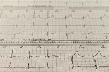 Electrocardiogram strips with cardiac arrhythmias. Ventricular escape beat. Selective focus on some beats. Free space to write.