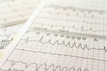 Electrocardiogram strips with cardiac arrhythmias. Ventricular tachycardia Selective focus on some beats. Free space to write.