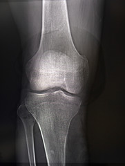 X-rays of the knee joint close up. Medicine