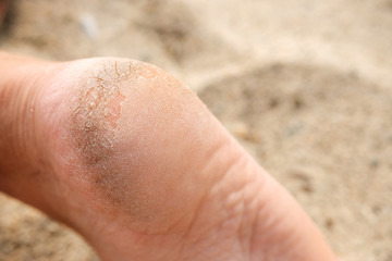 foot with damaged skin on the heel, cracks and hard parts of the skin