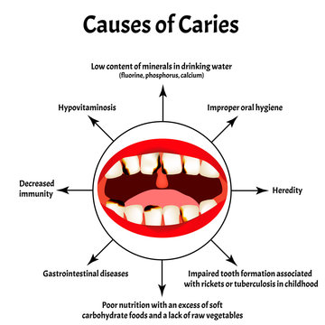Causes of caries. Smell from the mouth. Halitosis. The structure of the teeth and oral cavity. Diseases of the teeth. Infographics. Vector illustration on isolated background.