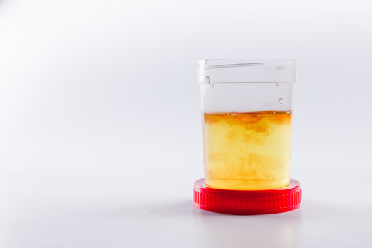 Cloudy or bloody urine sample in sterile plastic container on white background with, cloudy or bloody urine