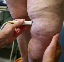 The varicose veins