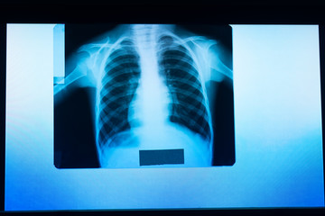x-ray image of the lungs, the picture is hanging on a medical negatoscope