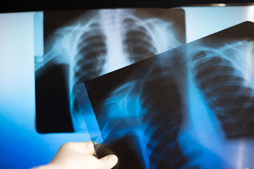 X-ray of the lungs, two pictures hanging on a medical negatoscope