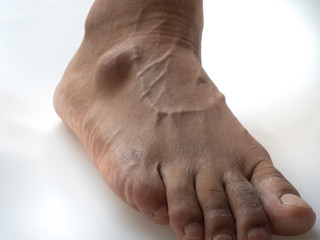 Big ganglion cysts,a sac of jellylike fluid,is on the right foot of man put on the white background.