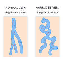 Varicose Veins Concept Banner Card with Elements Ad Poster Card. Vector