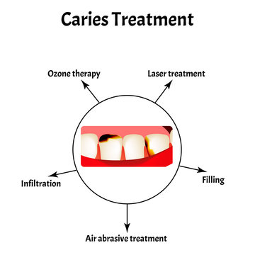 Caries treatment. Bad breath. Halitosis. The structure of the teeth and oral cavity with caries. Diseases of the teeth. Infographics. Vector illustration on isolated background.