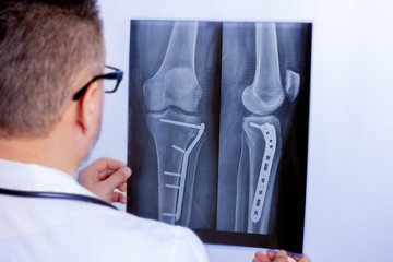 A male doctor examines an x-ray of the lower leg with a plate after surgery