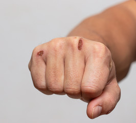 Fototapeta premium skin damage on the arm