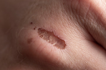 skin damage on the arm