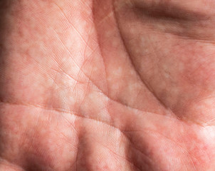 spotty skin on the palm of your hand as a background