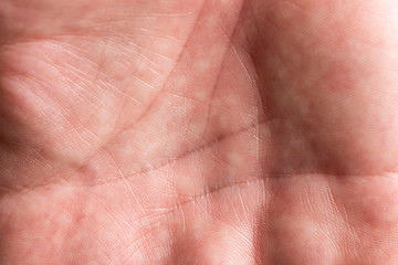 spotty skin on the palm of your hand as a background