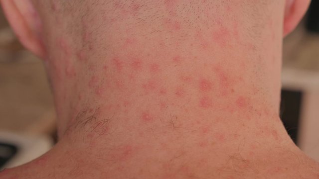 Close-up of the back and neck with rashes and blisters from chickenpox in an adult male. The hairy back and neck of an adult male with pimples from chickenpox.