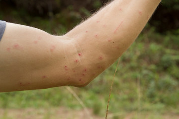 white man showing his arm with hives marks due to mosquito bites