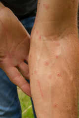 Fototapeta premium white man showing his arm with hives marks due to mosquito bites