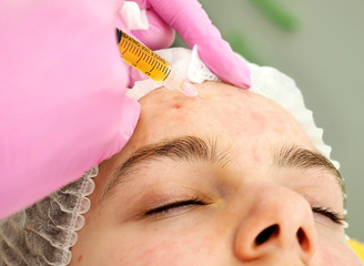 plasmolifting injection procedure. plasma injection into the skin of the patient's forehead....