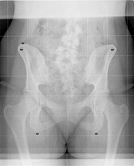 X Ray image show pelvis and both hips. X-ray of the hips, person with scoliosis. Woman hips with...