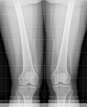 Two knees with a genu valgum x ray scan. Radiograph examination.