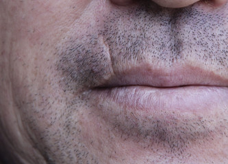 Scar on the lip. Cleft lip.
