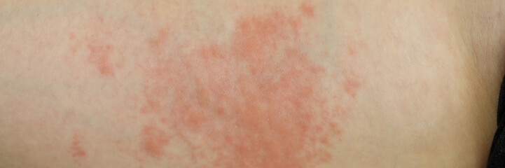 Focus on painful dermatological infection spreading throughout whole body of poor suffering...