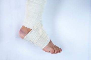 Woman's leg with sprained ankle with elastic bandage isolated on white background. Twisted bandaged ankle with bruise on white background.  Athlete runner training accident.