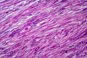 Uterine leiomyoma, light micrograph