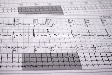 Heartbeat represented on paper. Cardiac arrhythmias. Selective focus on some beats. Extra systole ventricular Free space to write.