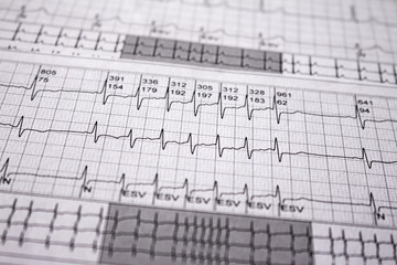 Heartbeat represented on paper. Cardiac arrhythmias. Selective focus on some beats. Supra ventricular tachycardia. Free space to write.