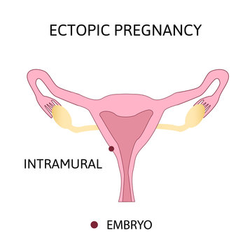 Ectopic Pregnancy. Types extra-uterine pregnancy. Intramural.