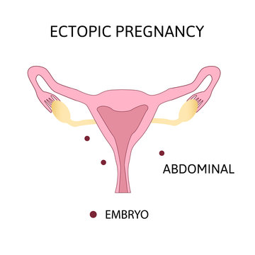 Ectopic Pregnancy. Type of extra-uterine pregnancy abdominal.
