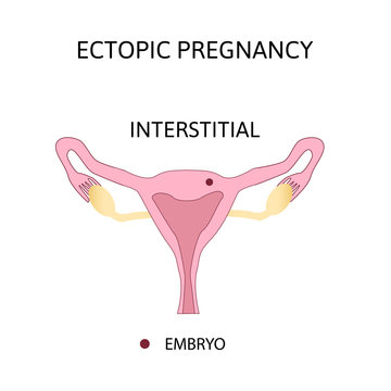 Ectopic Pregnancy. Types of extra-uterine pregnancy is interstitial.