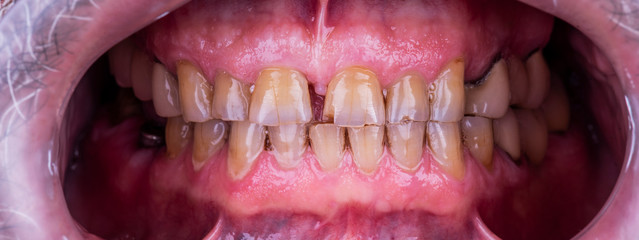 natural teeth before the dental treatment