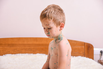 Young toddler,boy with chickenpox. Sick child with chickenpox. Varicella virus or Chickenpox bubble...