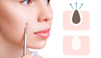 Young woman near infographic with blackhead cleansing.